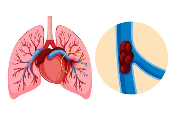 Pumonary Embolism