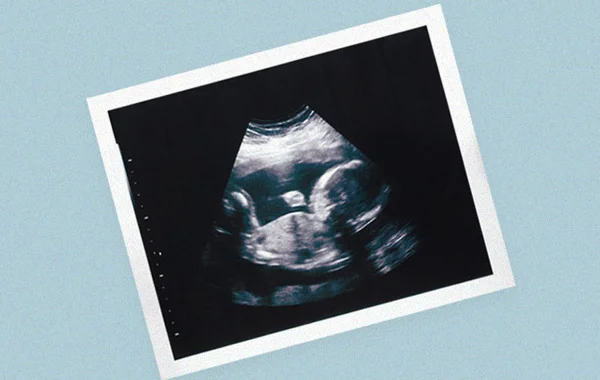 Ultrasound
